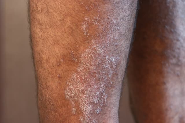 Skin Condition