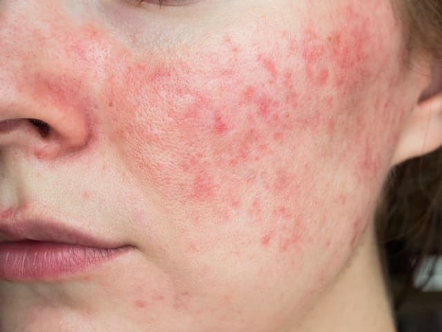 Skin Condition