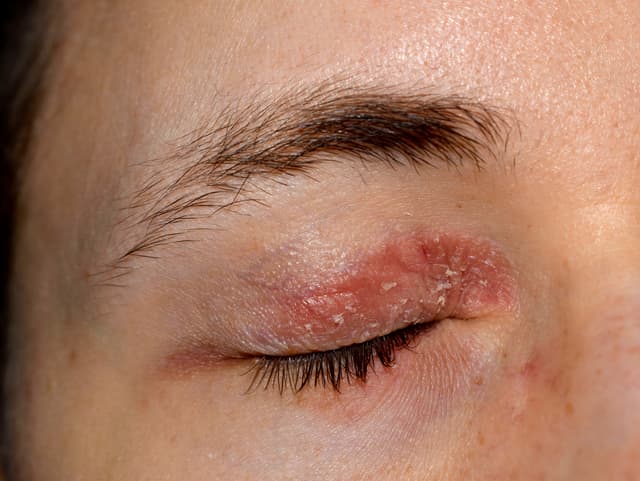 Skin Condition