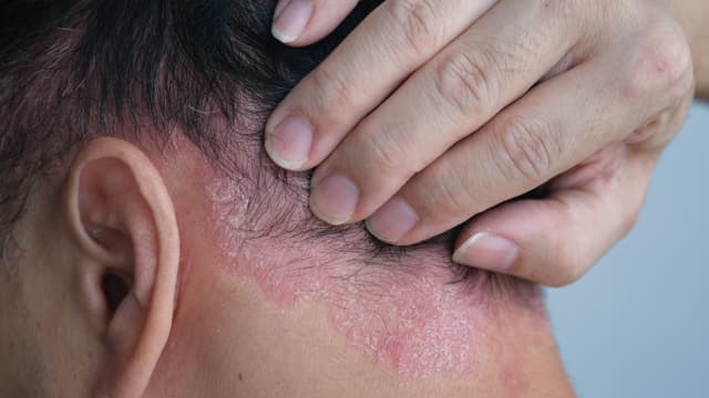 Skin Condition